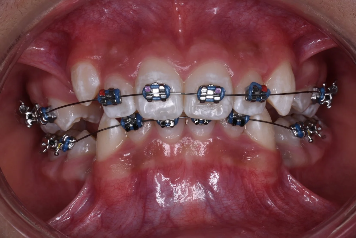 Brackets metálico 2