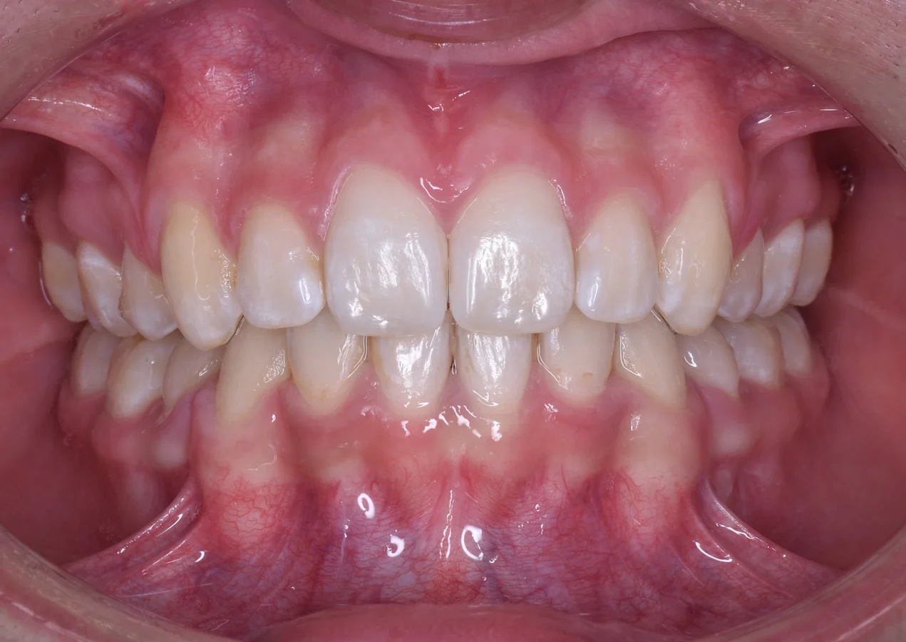 Brackets metálico 3