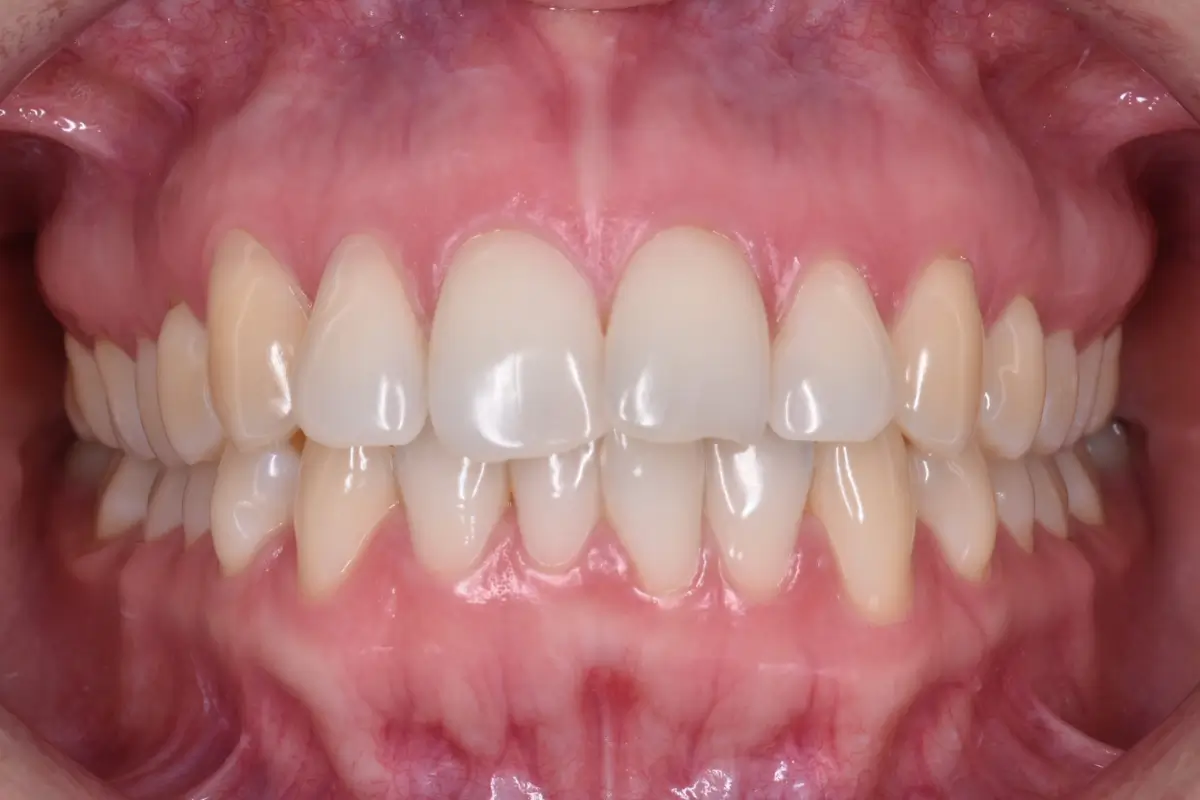 Alineadores1-1200x800