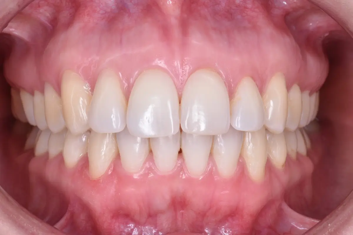 Alineadores2-1200x800