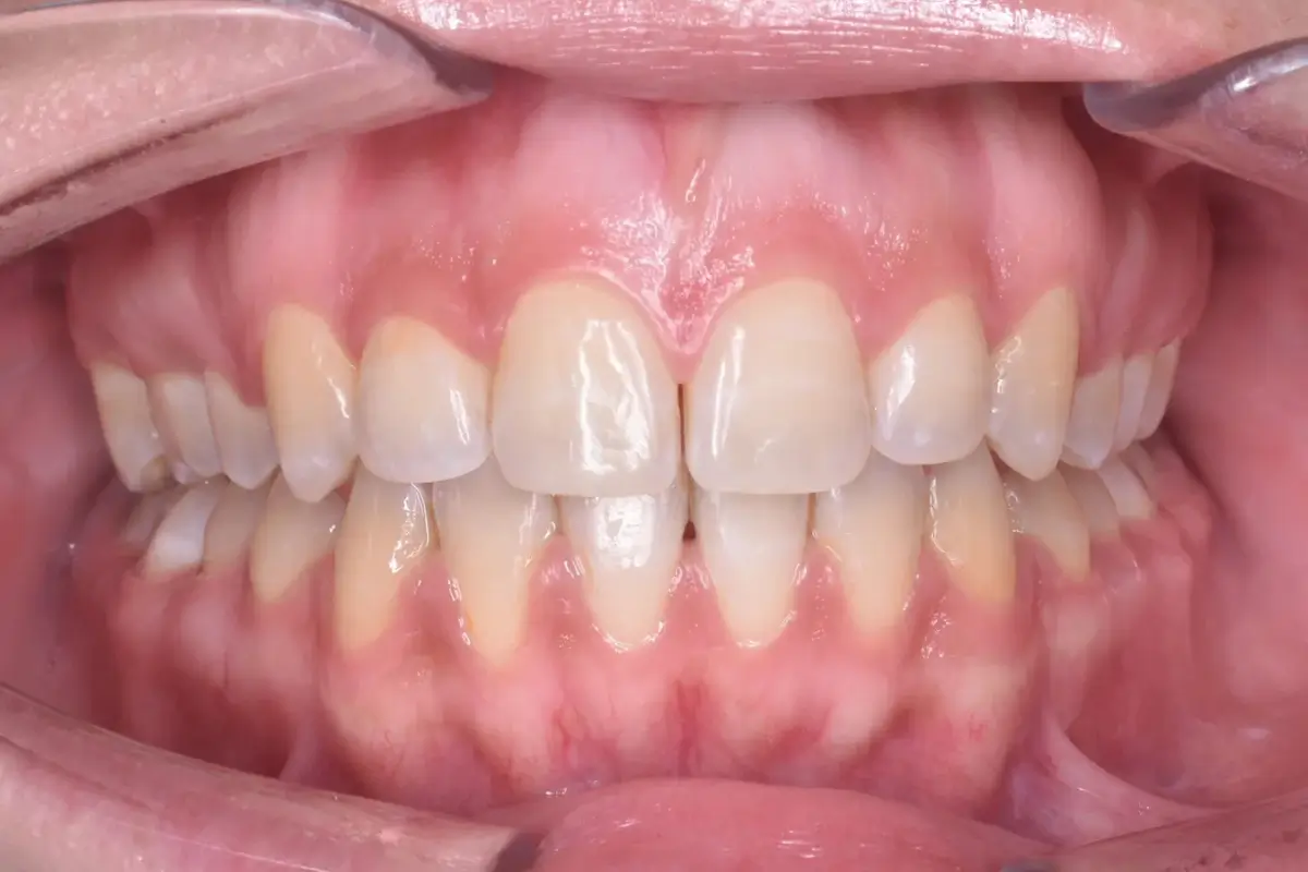 BracketsCeramicos2-1200x800