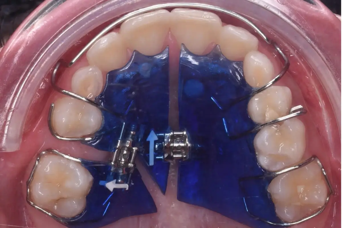 ortodonciaInterceptivaAntes1200x800