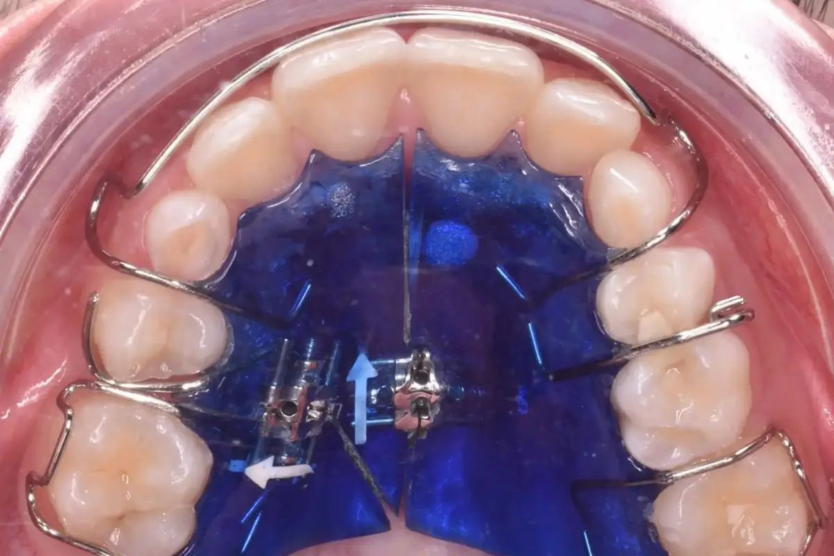 ortodonciaInterceptivaDespues1200x800